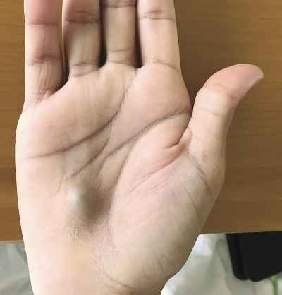Visit to dentist leaves man with bizarre lump on his hand, deadly heart infection
