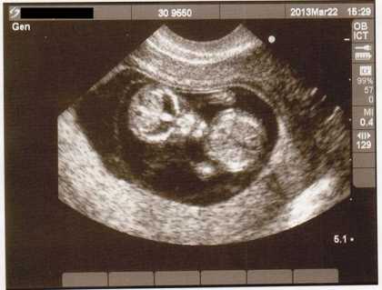 These ultrasound pictures will scare you. Are these human babies? One is definitely an alien...
