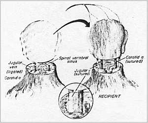 Human Head Transplant Surgery Is Now Possible, Says Neuroscientist #Science