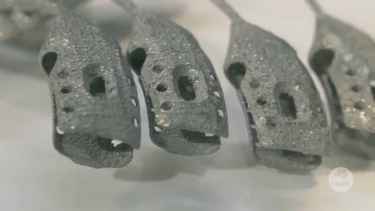 Cancer patient receives world's first 3D printed titanium sternum and rib cage in surgery